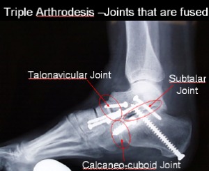 Triple-Arthrodesis-Resized