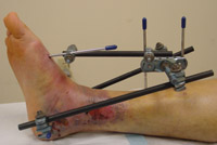 external fixator