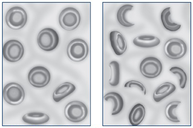 HEalthy red blood cells (left) are smooth and round. Blood cells damaged by E. coli toxins are misshapen and can clog blood vessels in the kidneys, causing HUS.