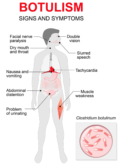 botulism symptoms dreamstime